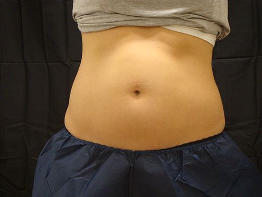 Photo of woman's abdomen before CoolSculpting®