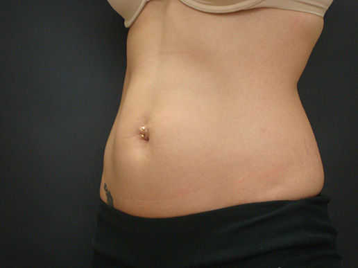 Photo of woman's abdomen before CoolSculpting®