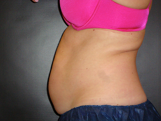 Abdomen before CoolSculpting