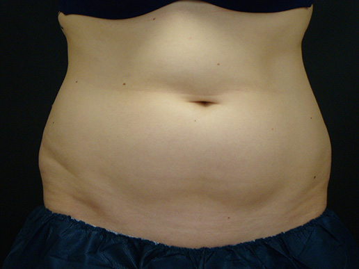 Abdomen - before CoolSculpting