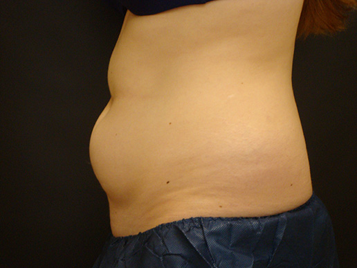 Abdomen before CoolSculpting