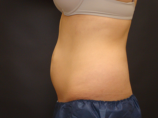 Abdomen before CoolSculpting®