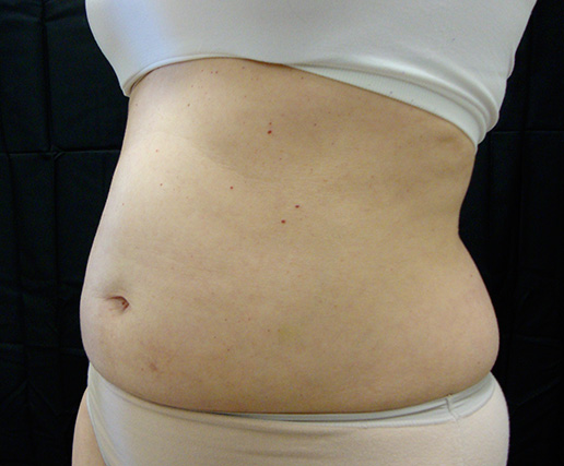 Abdomen before CoolSculpting®