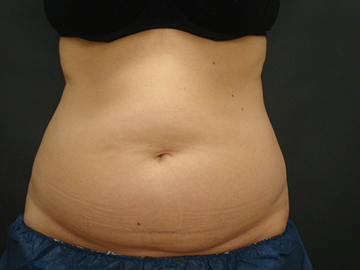 Abdomen before CoolSculpting®