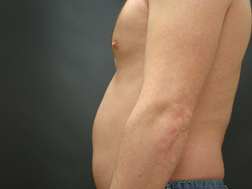 Photo of man's gynecomastia after CoolSculpting®