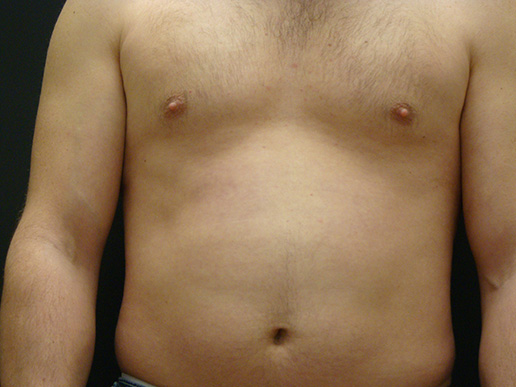 Photo of man's gynecomastia after CoolSculpting®