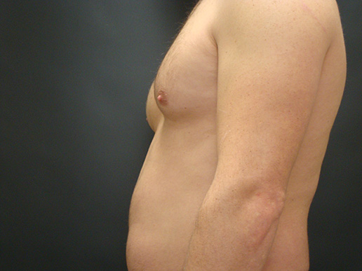 Photo of man's gynecomastia before CoolSculpting®