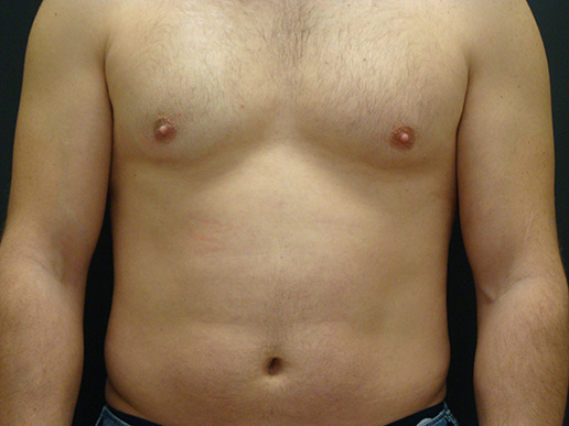 Photo of man's gynecomastia before CoolSculpting®