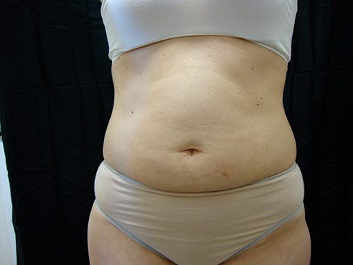 Abdomen -before CoolSculpting®