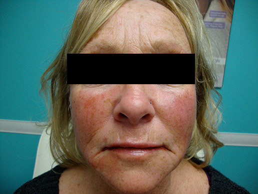 Cheek augmentation photo after dermal fillers