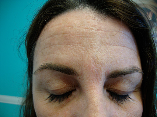 Photo of woman's glabellar line afterdermal fillers