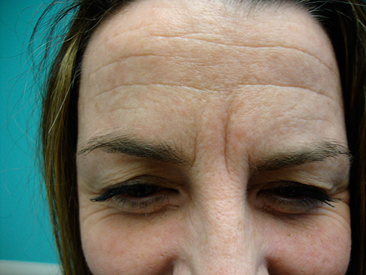 Photo of woman's glabellar line before dermal fillers