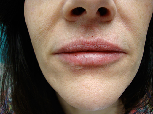 Photo of woman's lip augmentation after dermal fillers