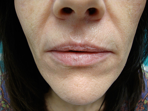 Photo of woman's lip augmentation before dermal fillers