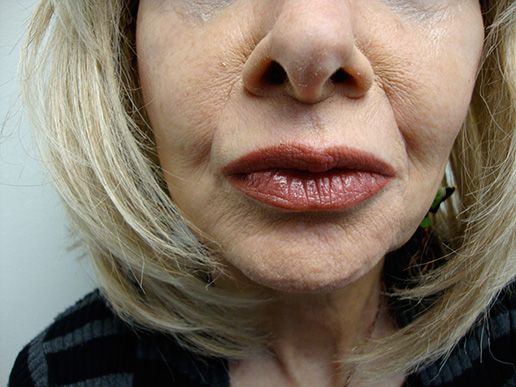 Photo of woman's lip lines after dermal fillers