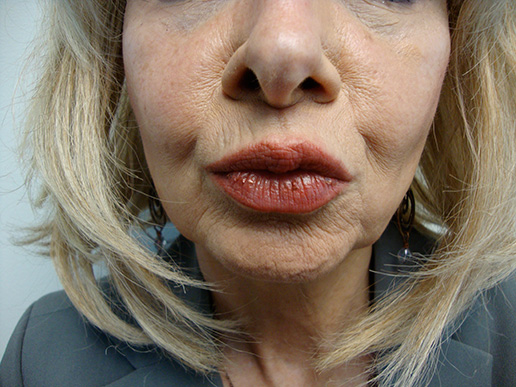 Photo of woman's lip lines before dermal fillers
