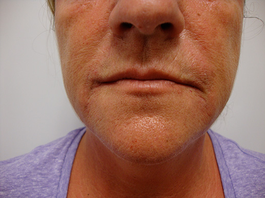 Photo of woman's marionette lines after dermal fillers