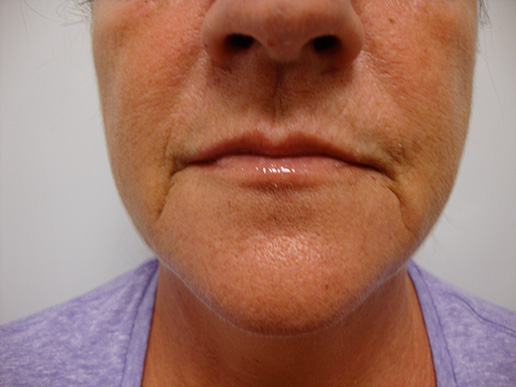 Photo of woman's marionette lines before dermal fillers