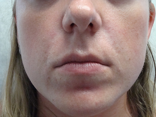 Photo of woman's nasolabial folds after dermal fillers