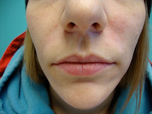 Photo of woman's nasolabial folds after dermal fillers