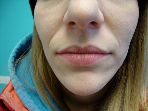 Photo of woman's nasolabial folds before dermal fillers