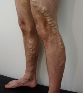 Photo of varicose veins before Sclerotherapy