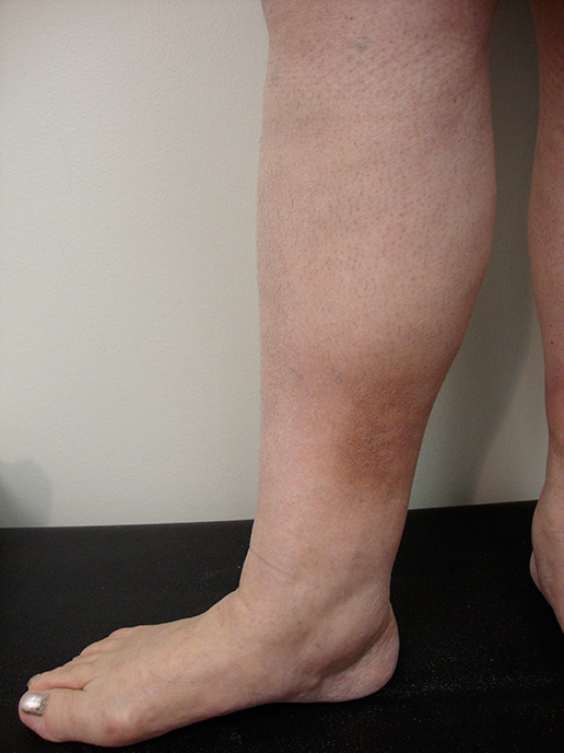 Photo of pre-ulcer hyperpigmentation after Sclerotherapy
