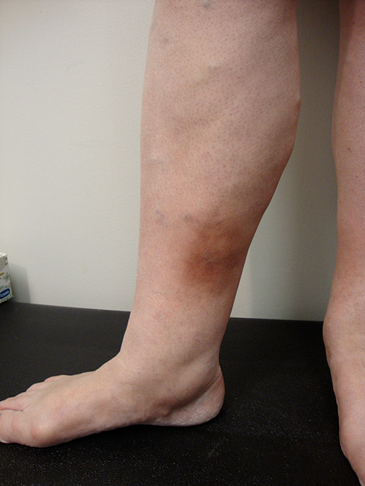 Photo of pre-ulcer hyperpigmentation before Sclerotherapy