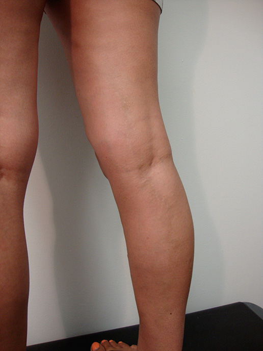 Photo of varicose veins on leg after Sclerotherapy