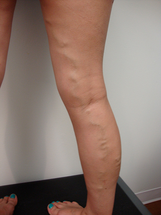 Photo of varicose veins on leg before Sclerotherapy