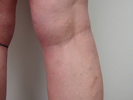 Photo of varicose veins after Sclerotherapy