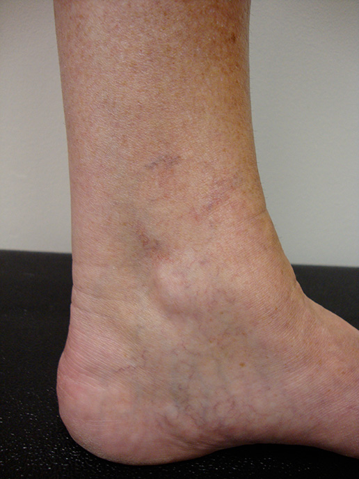 Photo of varicose veins after Sclerotherapy