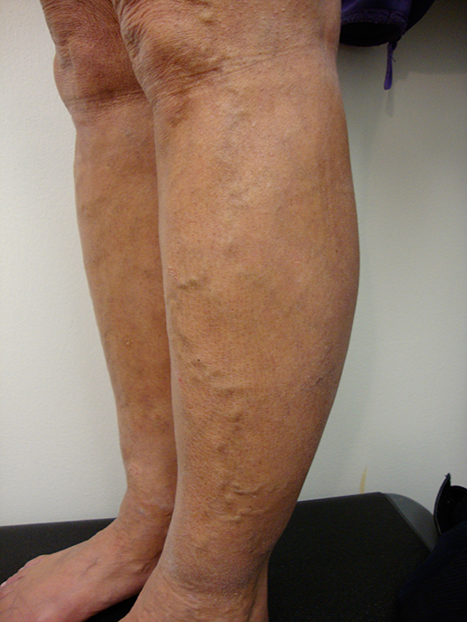 Photo of varicose veins before Sclerotherapy