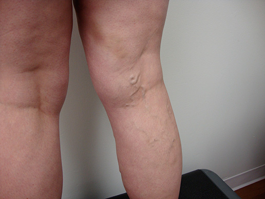 Photo of varicose veins before Sclerotherapy