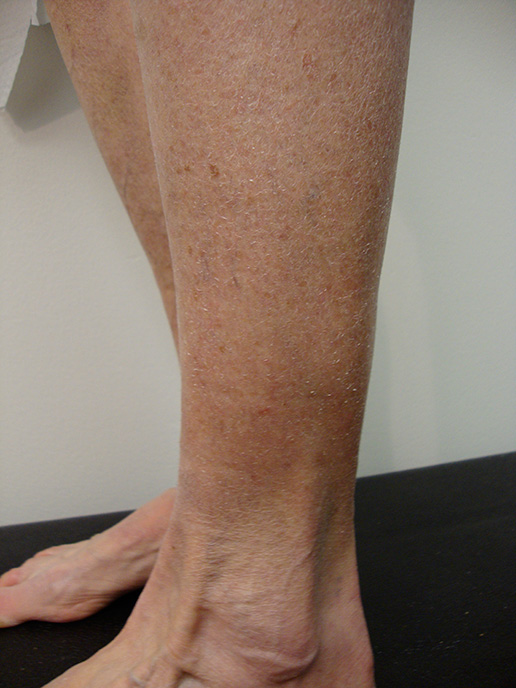 Photo of varicose veins on lower leg after Sclerotherapy