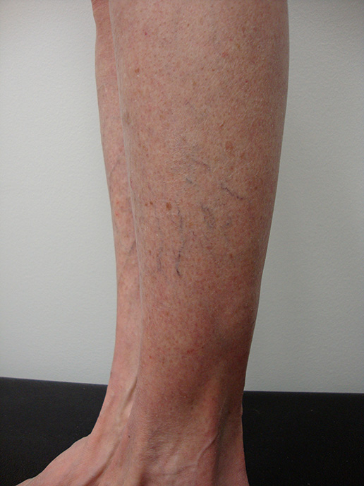 Photo of varicose veins on lower leg before Sclerotherapy