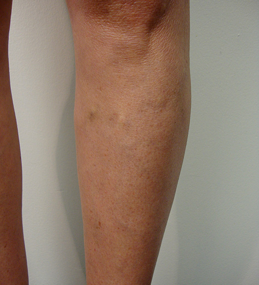 Photo of varicose veins on lower leg after Sclerotherapy