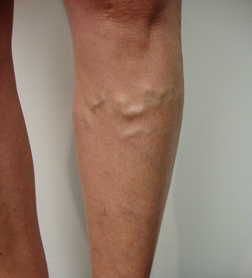 Photo of varicose veins on lower leg before Sclerotherapy