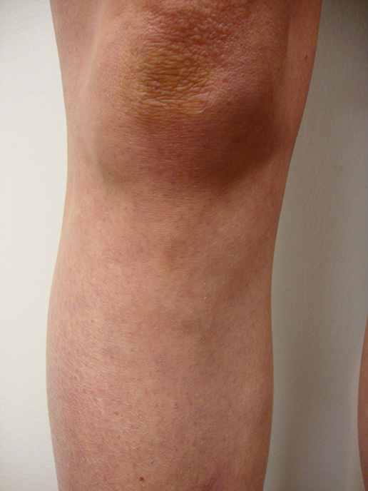 Photo of varicose veins after Sclerotherapy