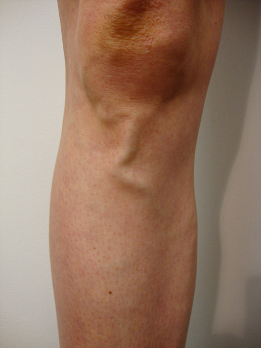 Photo of varicose veins before Sclerotherapy