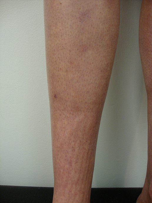 Photo of varicose veins after Sclerotherapy