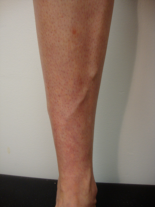 Photo of varicose veins before Sclerotherapy