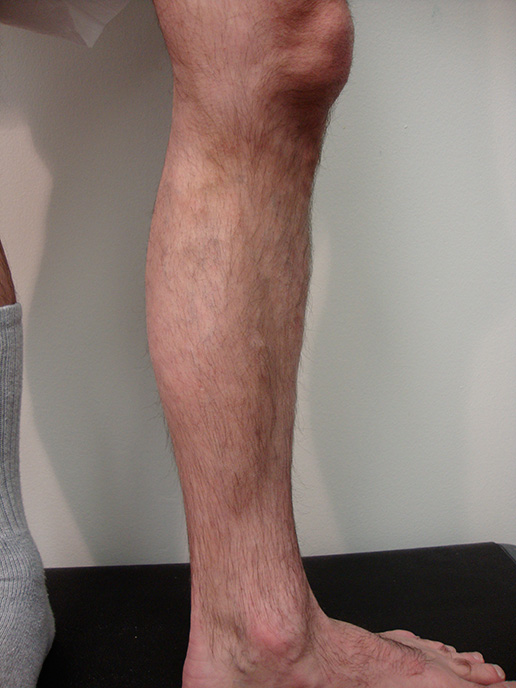 Photo of varicose veins on lower leg after Sclerotherapy