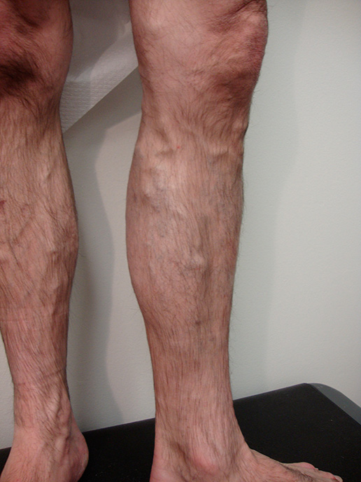 Photo of varicose veins on lower leg before Sclerotherapy