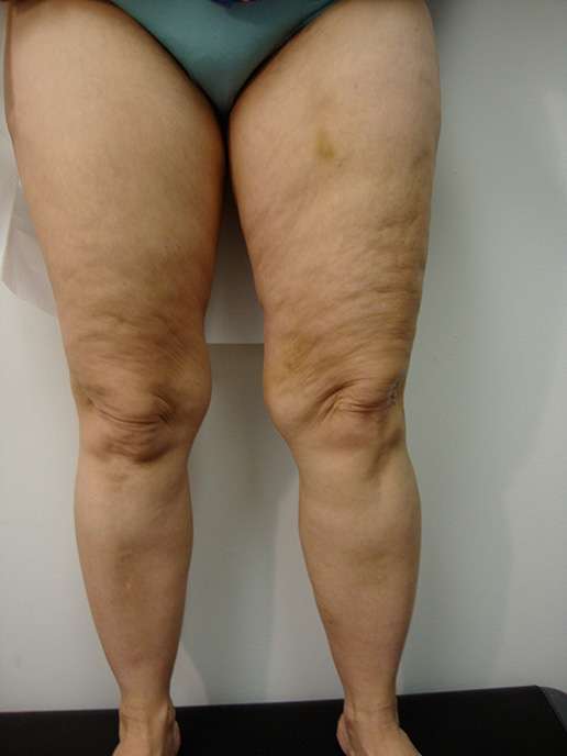 Photo of varicose veins on thigh after Sclerotherapy
