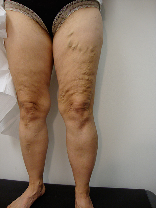 Photo of varicose veins on thigh before Sclerotherapy