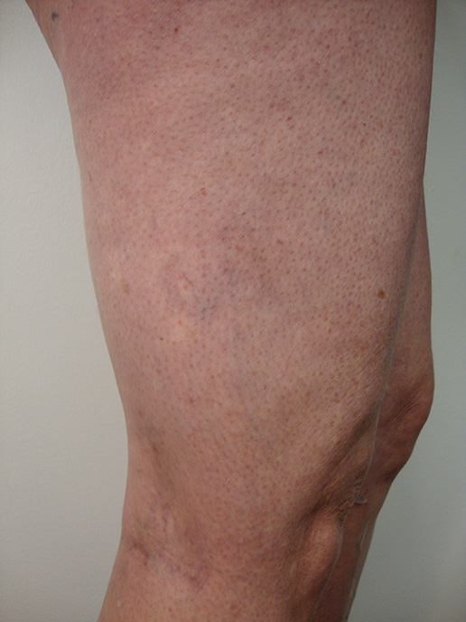 Photo of varicose veins on thigh after Sclerotherapy