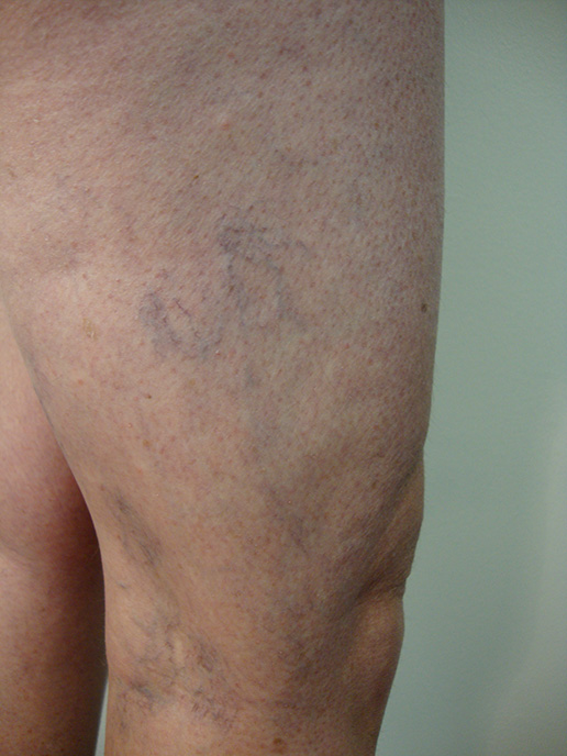 Photo of varicose veins on thigh before Sclerotherapy