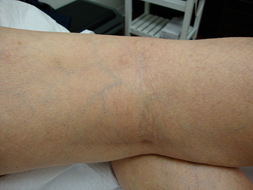Photo of spider veins after Sclerotherapy