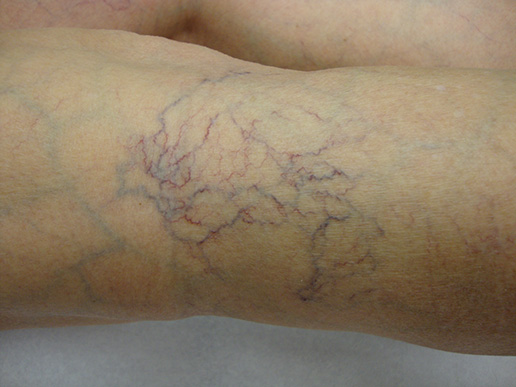 Photo of spider veins before Sclerotherapy